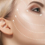 Sıvı Yüz Germe Nedir?