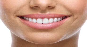 Gülüş Estetiği: Mükemmel Gülüşe Ulaşmanın Yolları