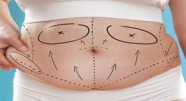 Karın Germe Ameliyatının Önemi ve Op. Dr. Gökhan Semerci’nin Uzmanlığı