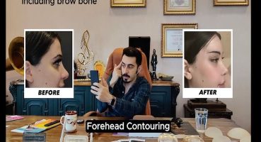 Yüz Estetiğinde Bütüncül Yaklaşım: Kapsamlı Yüz Feminizasyon Cerrahisi