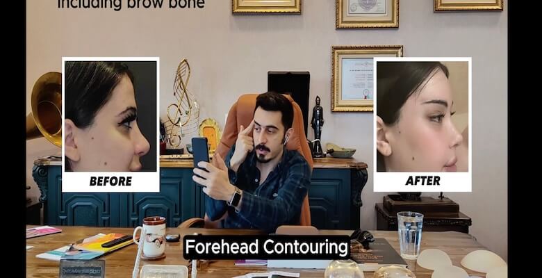 Yüz Estetiğinde Bütüncül Yaklaşım: Kapsamlı Yüz Feminizasyon Cerrahisi