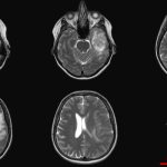 Beyin Tümörü Ameliyatı: Hangi Belirtiler Ameliyat Gerektirir?