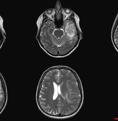 Beyin Tümörü Ameliyatı: Hangi Belirtiler Ameliyat Gerektirir?