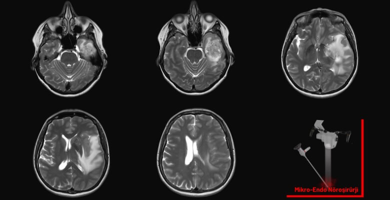 Beyin Tümörü Ameliyatı: Hangi Belirtiler Ameliyat Gerektirir?