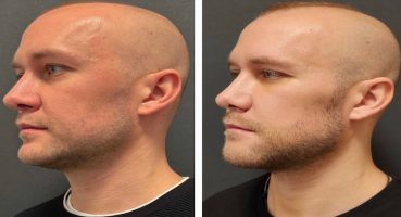 Yanak İmplantı ile Yüz Hacmini Arttırma Rehberi