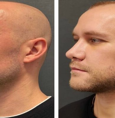 Yanak İmplantı ile Yüz Hacmini Arttırma Rehberi