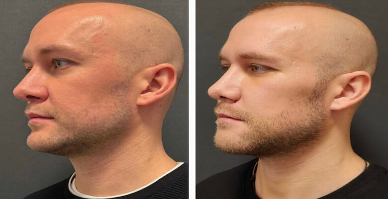 Yanak İmplantı ile Yüz Hacmini Arttırma Rehberi